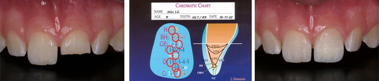 anterior composite resorations