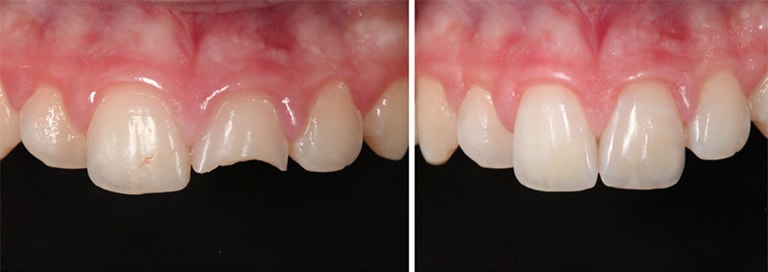 IV Restorations