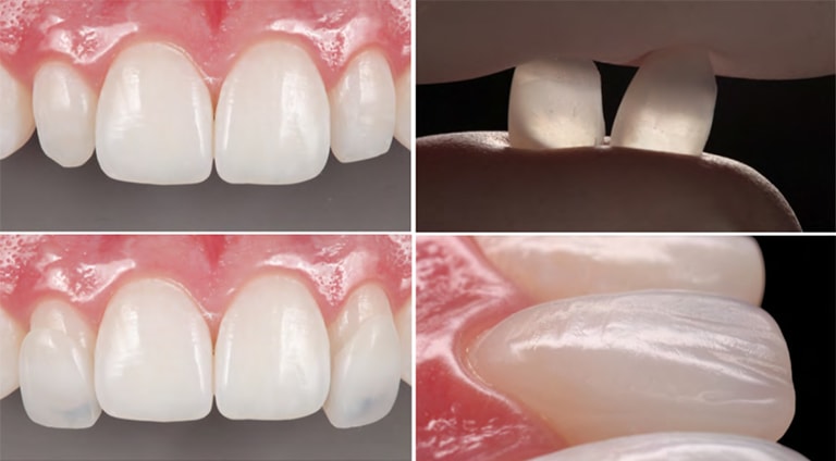 Lateral Incisor Veneers