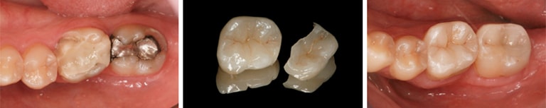 posterior aesthetic restorations